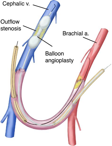 Carotid brachiobasilic loop graft apex of the loop